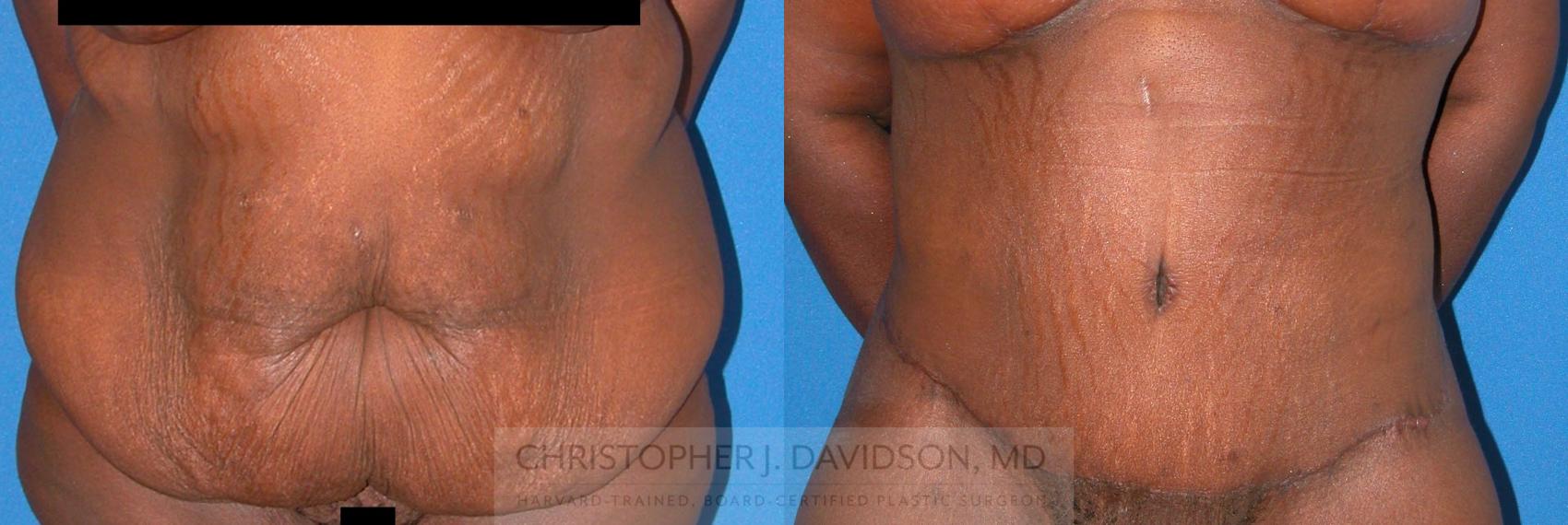 Lower Body Lift Case 75 Before & After View #1 | Boston, MA | Christopher J. Davidson, MD