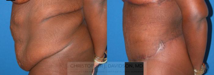 Lower Body Lift Case 75 Before & After View #2 | Boston, MA | Christopher J. Davidson, MD
