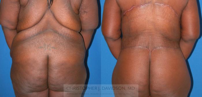 Lower Body Lift Case 75 Before & After View #3 | Boston, MA | Christopher J. Davidson, MD