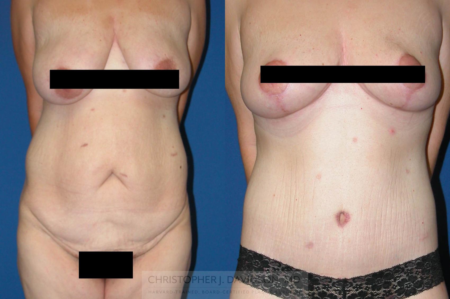 Breast Lift Case 87 Before & After View #1 | Wellesley, MA | Christopher J. Davidson, MD