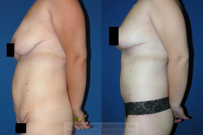 Lower Body Lift Case 87 Before & After View #2 | Boston, MA | Christopher J. Davidson, MD