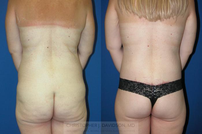 Lower Body Lift Case 87 Before & After View #3 | Boston, MA | Christopher J. Davidson, MD