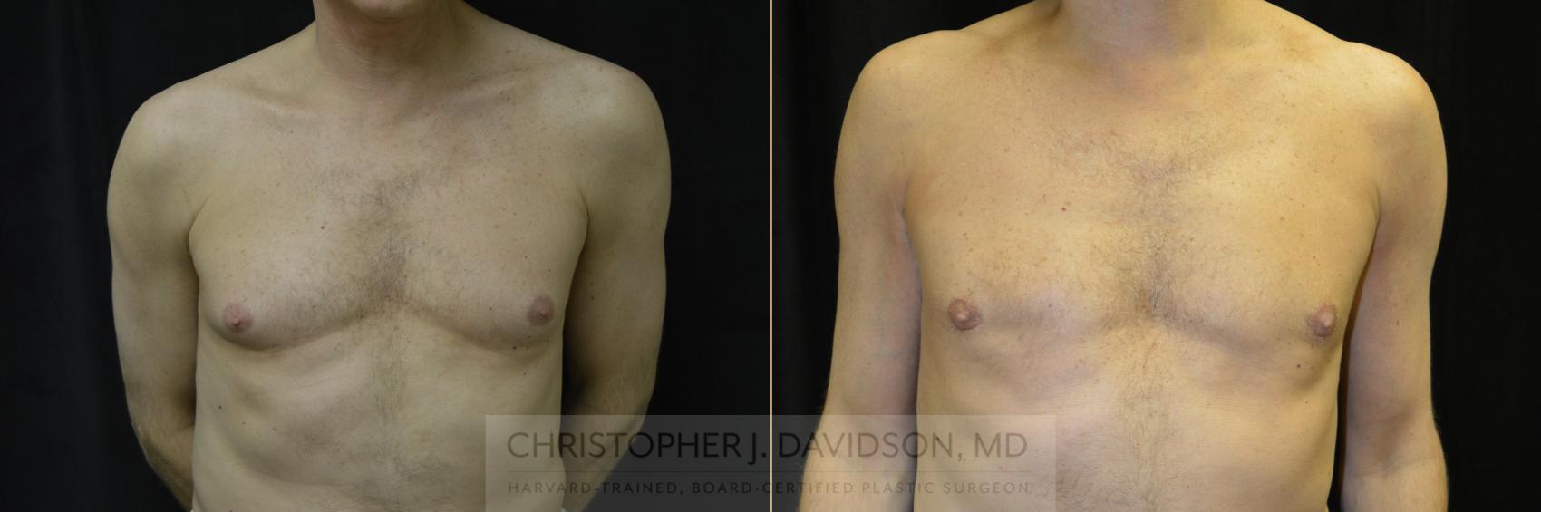 Male Breast Reduction Case 126 Before & After View #1 | Wellesley, MA | Christopher J. Davidson, MD