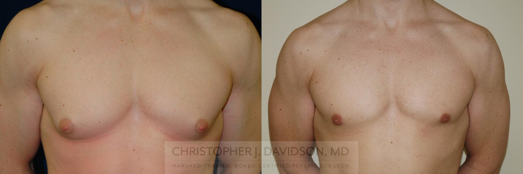 Male Breast Reduction Case 144 Before & After View #1 | Wellesley, MA | Christopher J. Davidson, MD