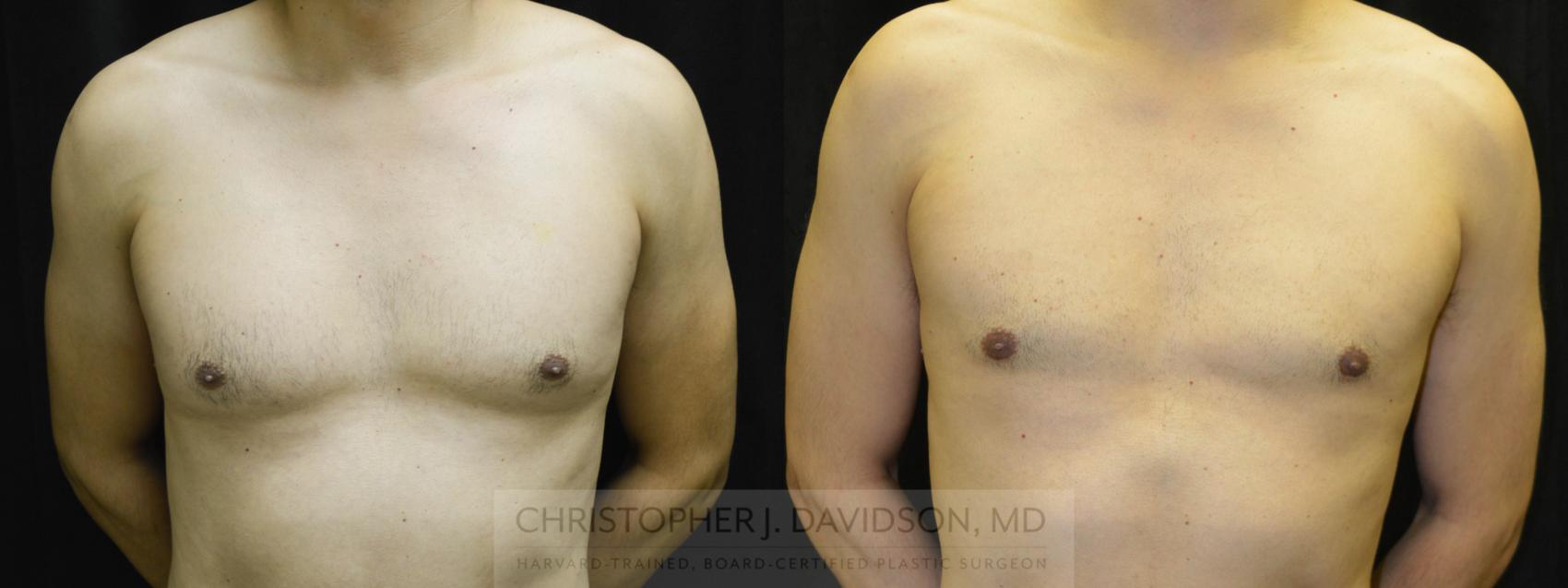 Male Breast Reduction Case 22 Before & After View #1 | Wellesley & Boston, MA | Christopher J. Davidson, MD