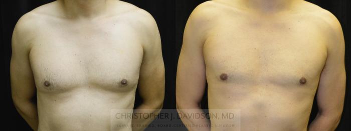 Male Breast Reduction Case 22 Before & After View #1 | Wellesley, MA | Christopher J. Davidson, MD