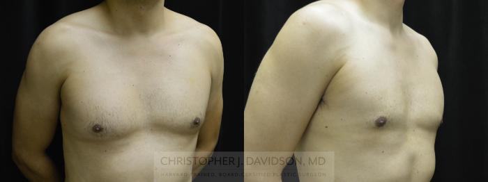 Male Breast Reduction Case 22 Before & After View #2 | Boston, MA | Christopher J. Davidson, MD