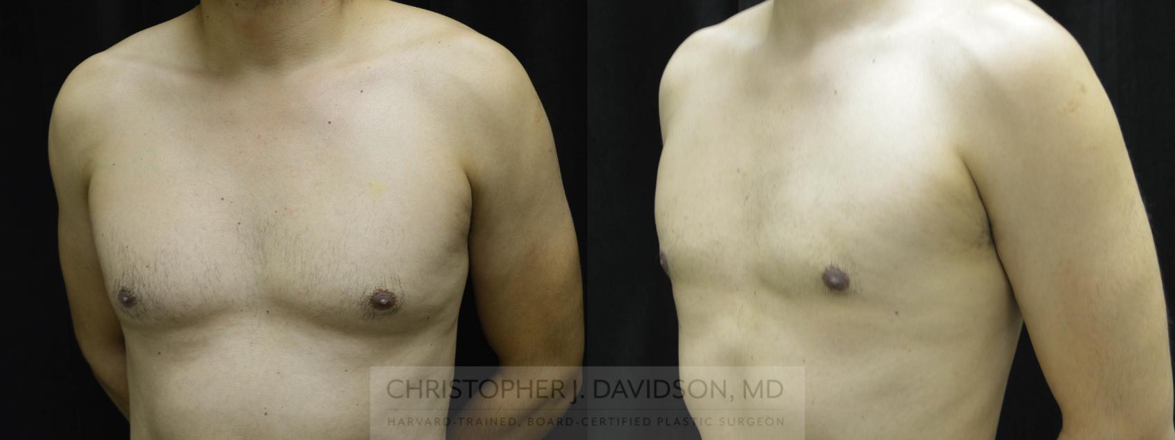 Male Breast Reduction Case 22 Before & After View #3 | Wellesley, MA | Christopher J. Davidson, MD