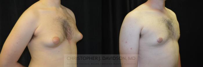 Male Breast Reduction Case 249 Before & After View #2 | Boston, MA | Christopher J. Davidson, MD