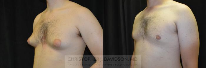 Male Breast Reduction Case 249 Before & After View #3 | Boston, MA | Christopher J. Davidson, MD
