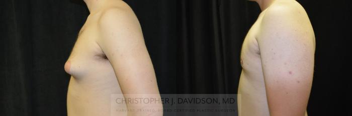 Male Breast Reduction Case 249 Before & After View #4 | Boston, MA | Christopher J. Davidson, MD