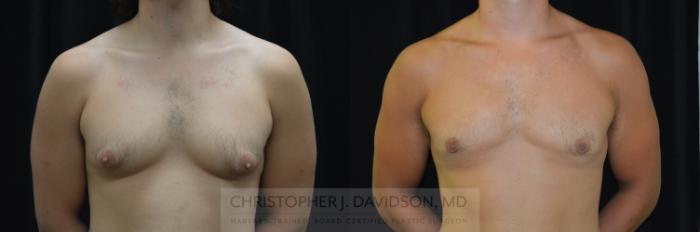 Male Breast Reduction Case 300 Before & After Front | Wellesley, MA | Christopher J. Davidson, MD