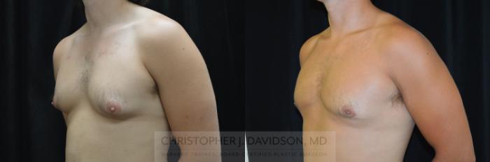 Male Breast Reduction Case 300 Before & After Left Oblique | Boston, MA | Christopher J. Davidson, MD