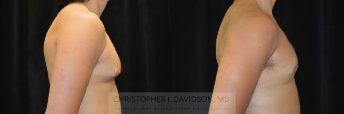 Male Breast Reduction Case 300 Before & After Right Side | Boston, MA | Christopher J. Davidson, MD