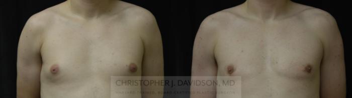 Male Breast Reduction Case 452 Before & After Front | Boston, MA | Christopher J. Davidson, MD