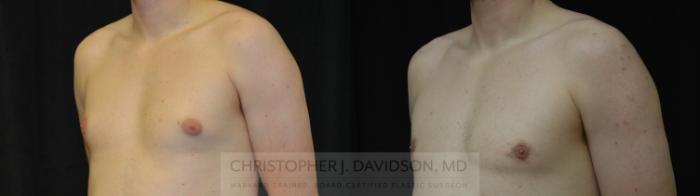 Male Breast Reduction Case 452 Before & After Left Oblique | Boston, MA | Christopher J. Davidson, MD