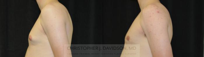 Male Breast Reduction Case 452 Before & After Left Side | Boston, MA | Christopher J. Davidson, MD