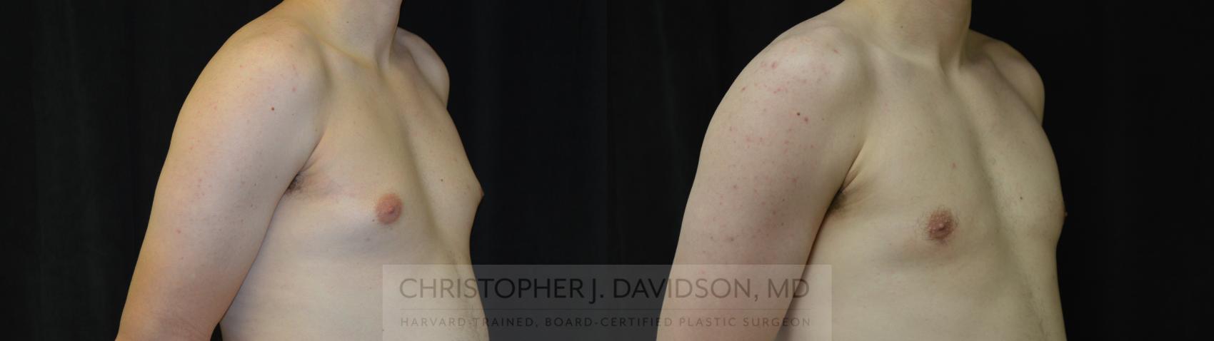 Male Breast Reduction Case 452 Before & After Right Oblique | Boston, MA | Christopher J. Davidson, MD