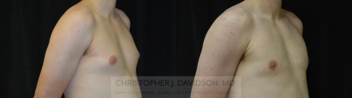 Male Breast Reduction Case 452 Before & After Right Oblique | Boston, MA | Christopher J. Davidson, MD