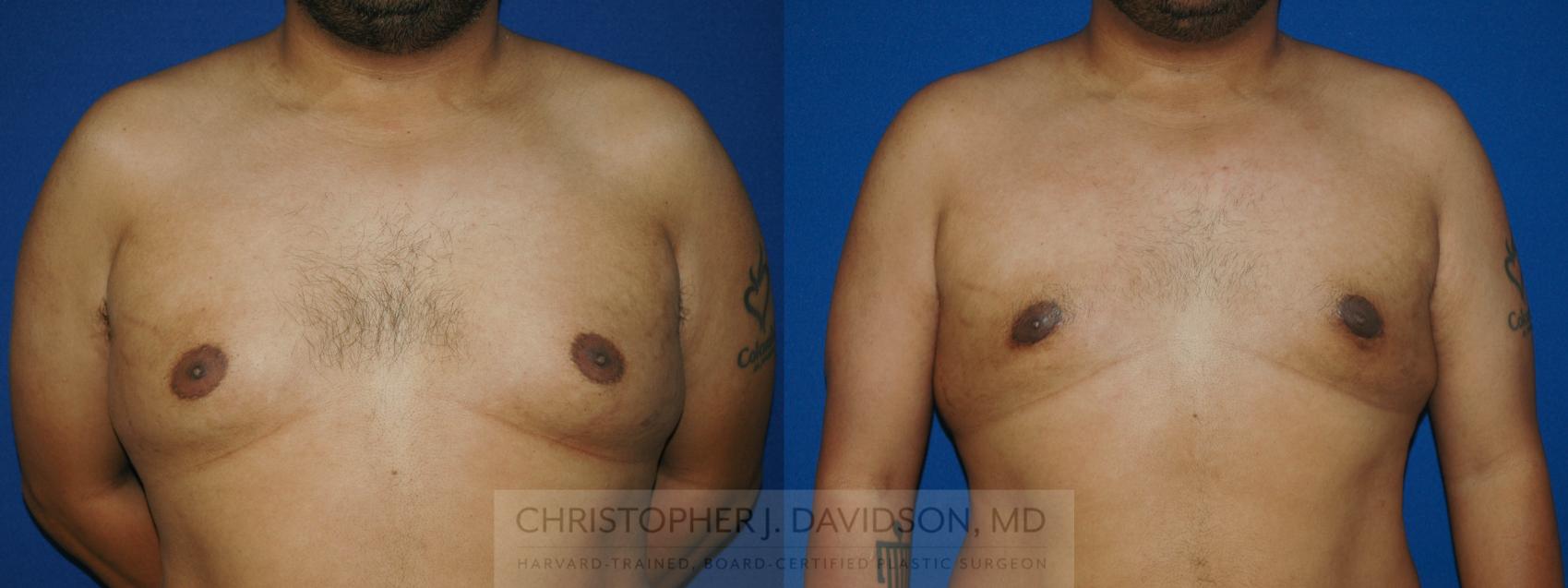 Male Breast Reduction Case 48 Before & After View #1 | Wellesley, MA | Christopher J. Davidson, MD
