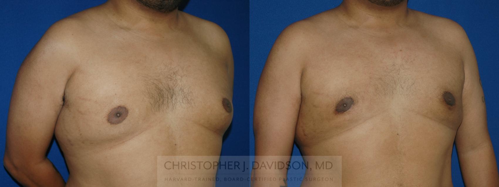 Male Breast Reduction Case 48 Before & After View #2 | Wellesley, MA | Christopher J. Davidson, MD