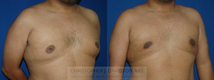 Male Breast Reduction Case 48 Before & After View #2 | Boston, MA | Christopher J. Davidson, MD