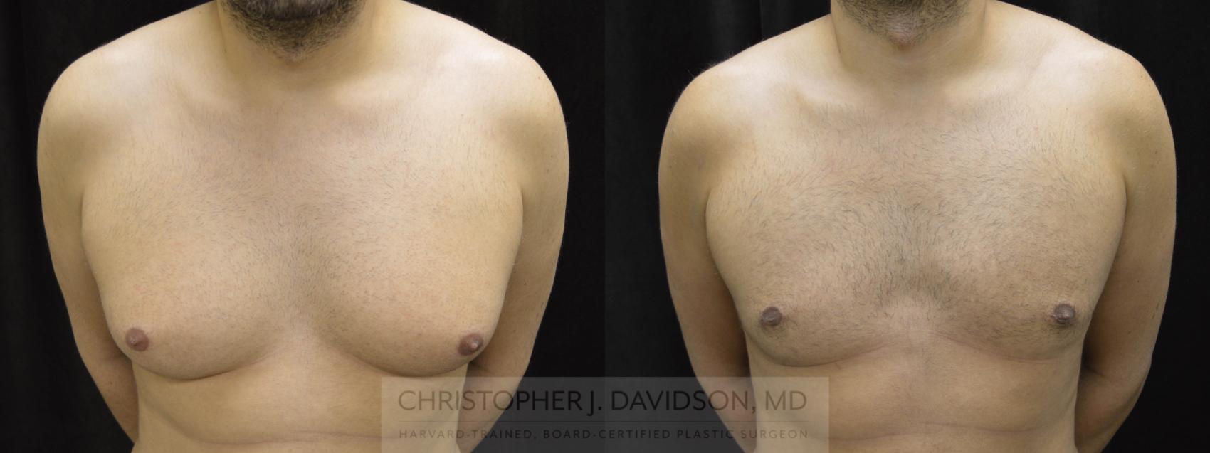 Male Breast Reduction Case 61 Before & After View #1 | Wellesley, MA | Christopher J. Davidson, MD