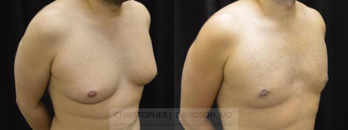 Male Breast Reduction Case 61 Before & After View #2 | Boston, MA | Christopher J. Davidson, MD