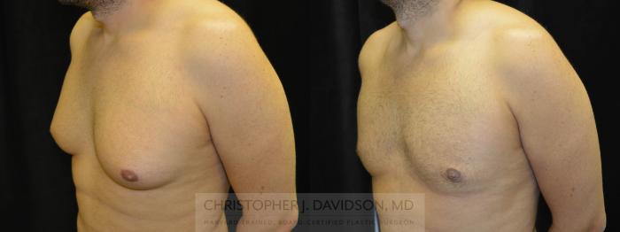Male Breast Reduction Case 61 Before & After View #3 | Boston, MA | Christopher J. Davidson, MD