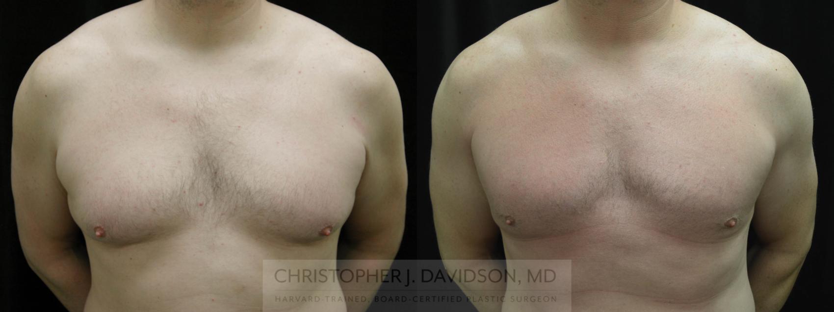 Male Breast Reduction Case 65 Before & After View #1 | Wellesley & Boston, MA | Christopher J. Davidson, MD