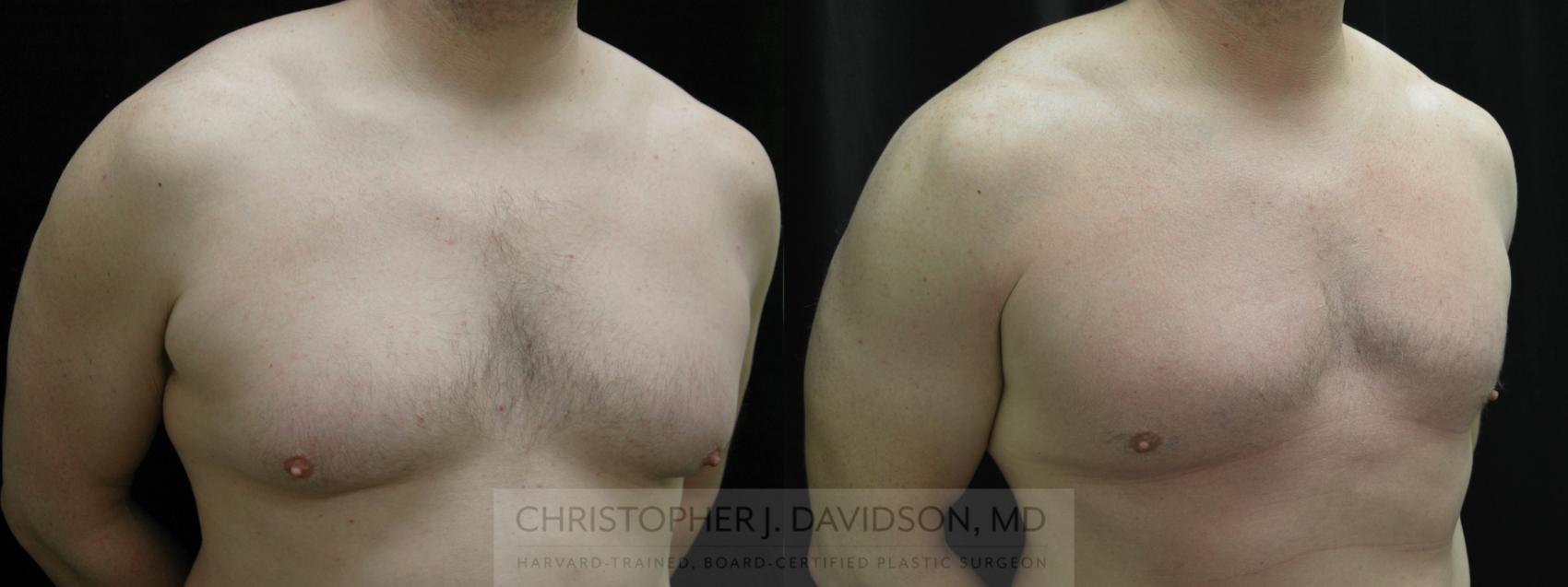 Male Breast Reduction Case 65 Before & After View #2 | Wellesley, MA | Christopher J. Davidson, MD