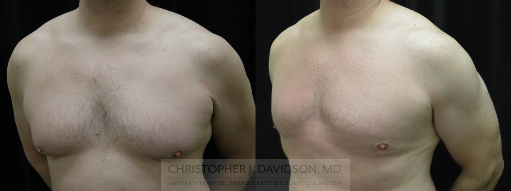 Male Breast Reduction Case 65 Before & After View #3 | Wellesley, MA | Christopher J. Davidson, MD