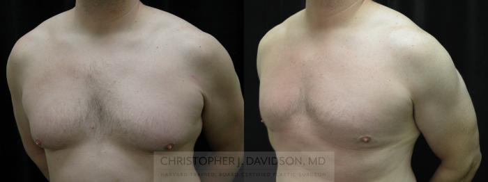 Male Breast Reduction Case 65 Before & After View #3 | Boston, MA | Christopher J. Davidson, MD