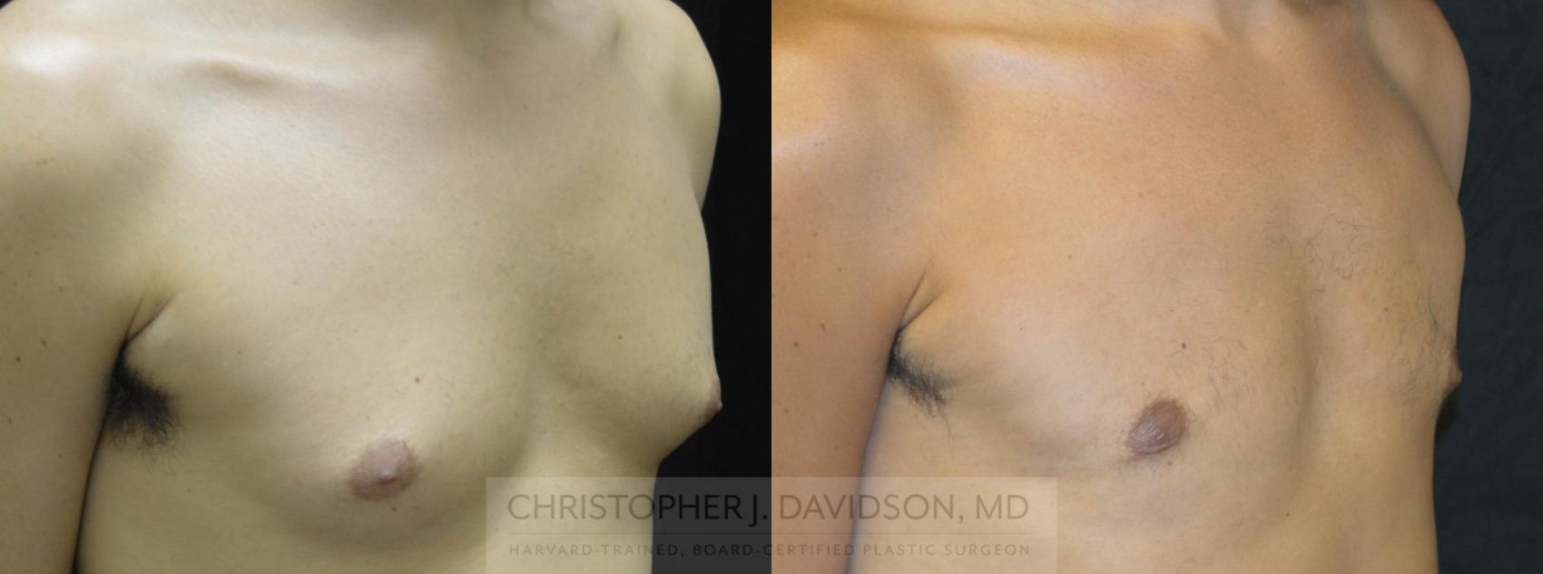 Male Breast Reduction Case 70 Before & After View #1 | Boston, MA | Christopher J. Davidson, MD