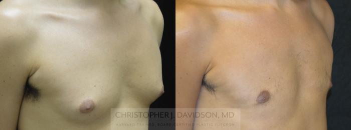 Male Breast Reduction Case 70 Before & After View #1 | Wellesley, MA | Christopher J. Davidson, MD