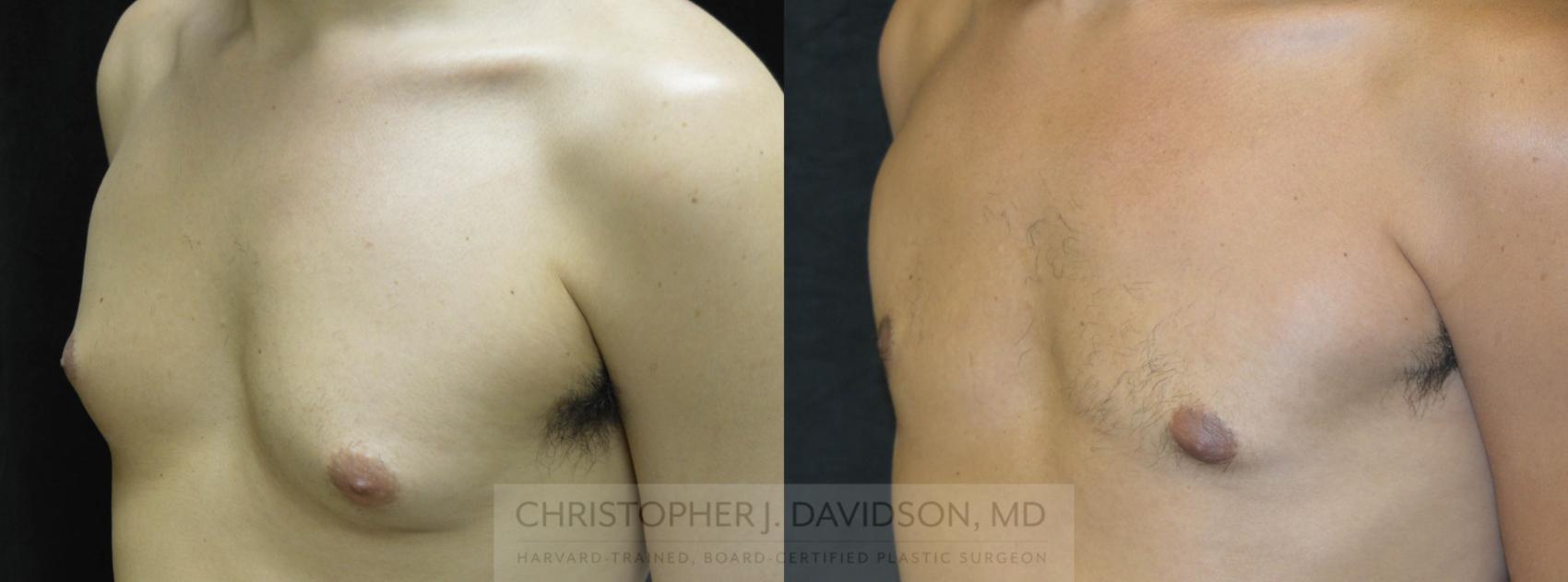 Male Breast Reduction Case 70 Before & After View #2 | Wellesley, MA | Christopher J. Davidson, MD