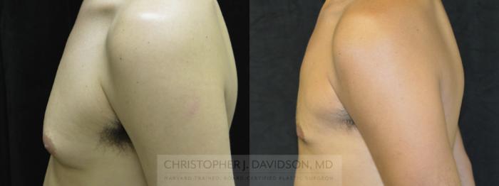 Male Breast Reduction Case 70 Before & After View #3 | Boston, MA | Christopher J. Davidson, MD