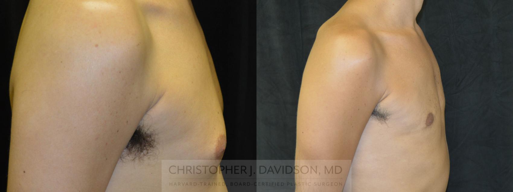 Male Breast Reduction Case 70 Before & After View #4 | Wellesley, MA | Christopher J. Davidson, MD