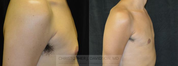 Male Breast Reduction Case 70 Before & After View #4 | Boston, MA | Christopher J. Davidson, MD