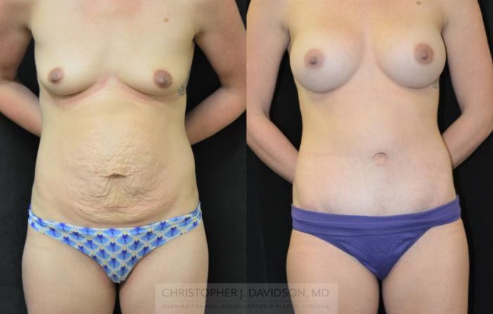 Mommy Makeover Case 294 Before & After Front | Boston, MA | Christopher J. Davidson, MD