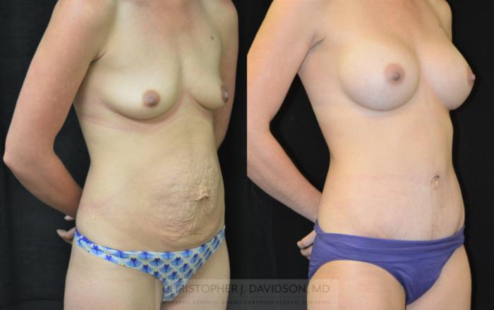 Mommy Makeover Case 294 Before & After Right Oblique | Boston, MA | Christopher J. Davidson, MD