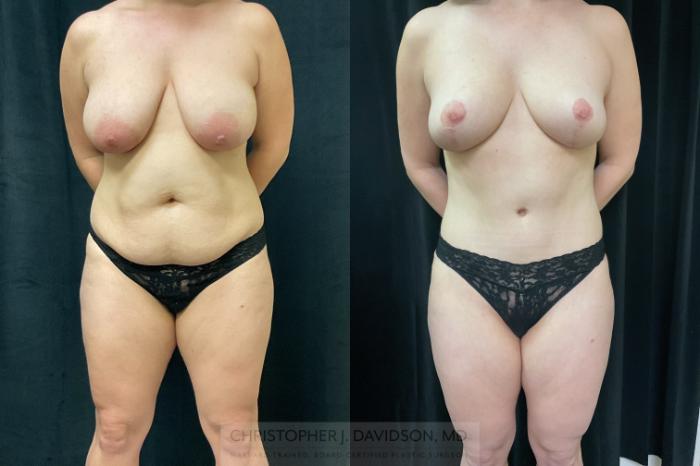 Mommy Makeover Case 350 Before & After Front | Boston, MA | Christopher J. Davidson, MD