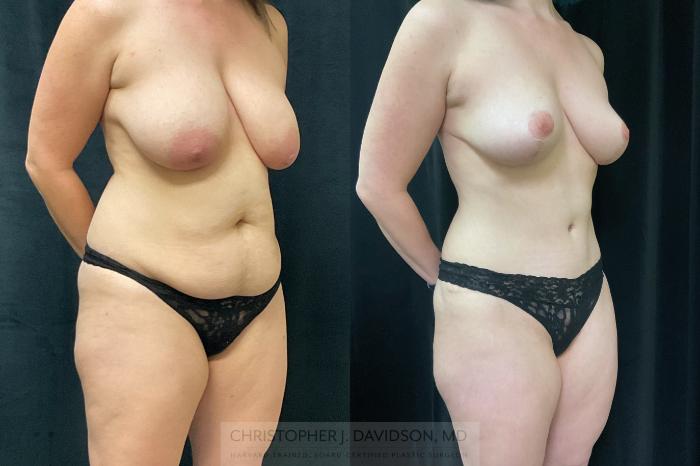 Mommy Makeover Case 350 Before & After Right Oblique | Boston, MA | Christopher J. Davidson, MD