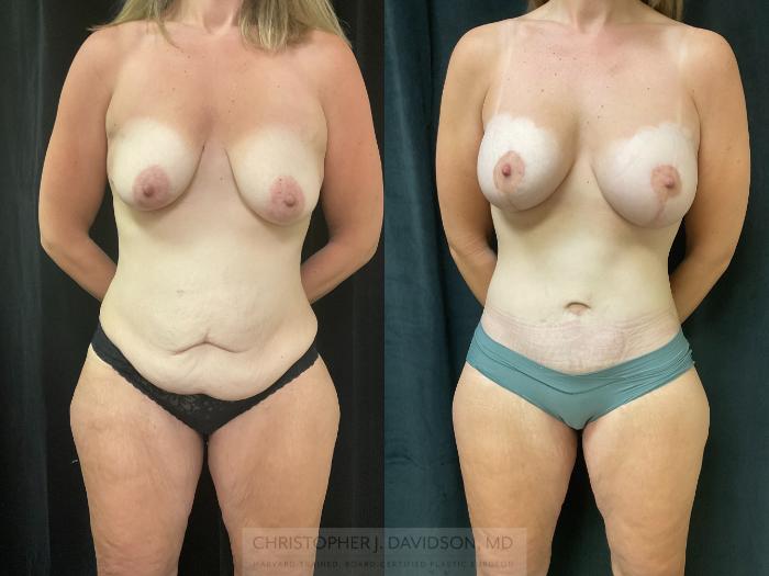 Breast Lift with Implants Case 360 Before & After Front | Boston, MA | Christopher J. Davidson, MD
