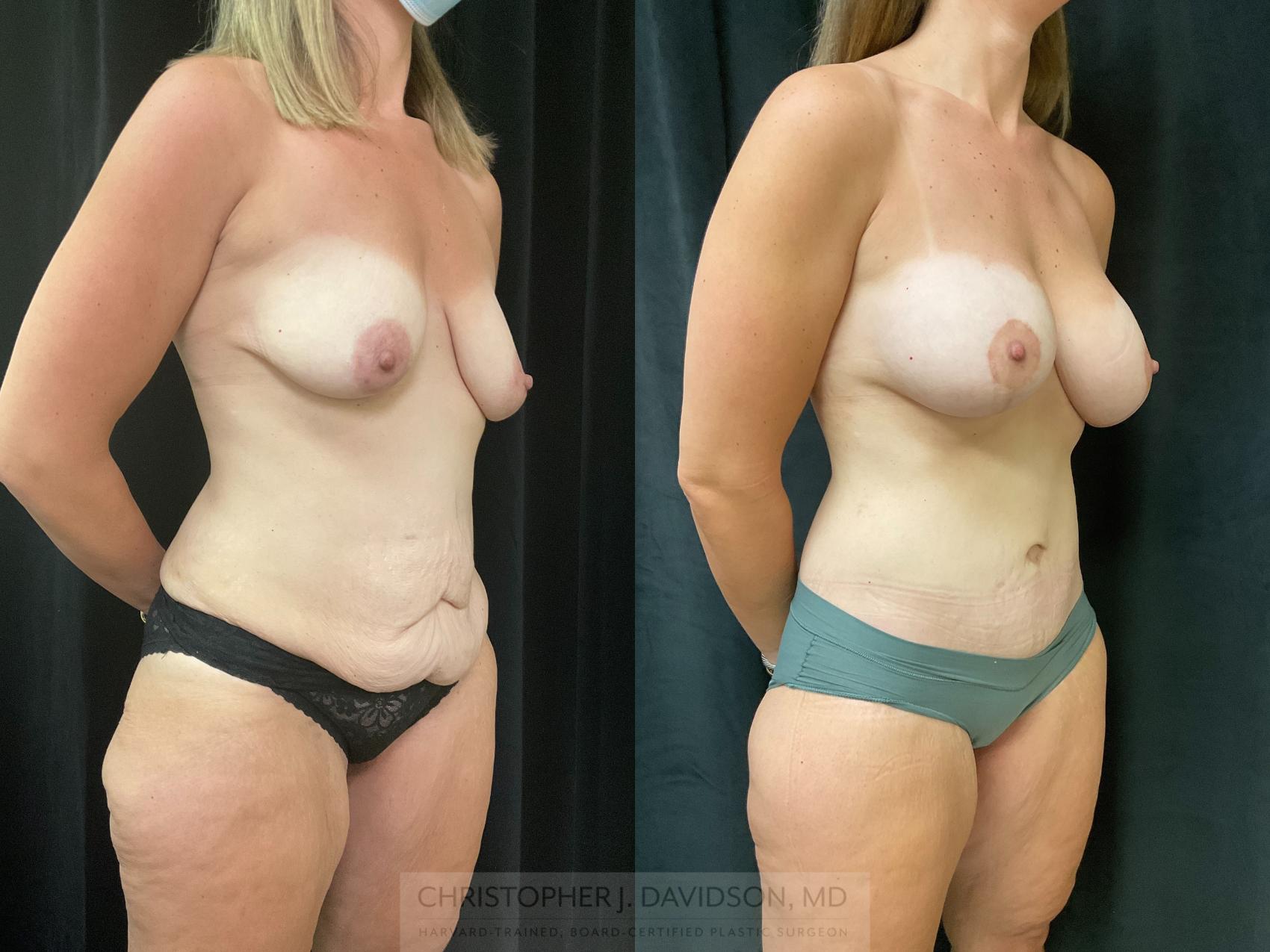 Tummy Tuck (Abdominoplasty) Case 360 Before & After Right Oblique | Boston, MA | Christopher J. Davidson, MD