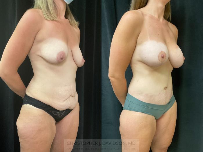 Tummy Tuck (Abdominoplasty) Case 360 Before & After Right Oblique | Boston, MA | Christopher J. Davidson, MD