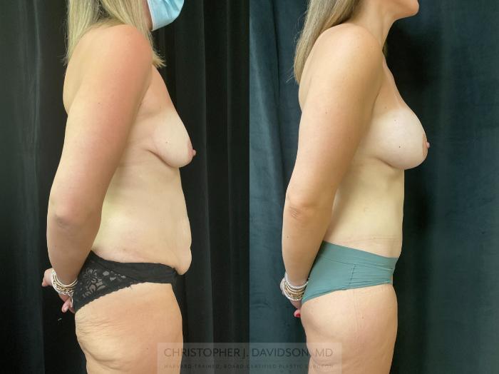 Breast Lift with Implants Case 360 Before & After Right Side | Boston, MA | Christopher J. Davidson, MD