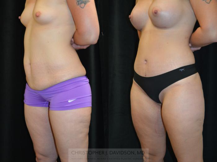 Mommy Makeover Case 379 Before & After Left Oblique | Boston, MA | Christopher J. Davidson, MD