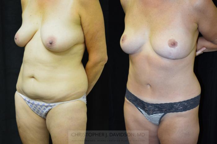 Mommy Makeover Case 401 Before & After Left Oblique | Boston, MA | Christopher J. Davidson, MD