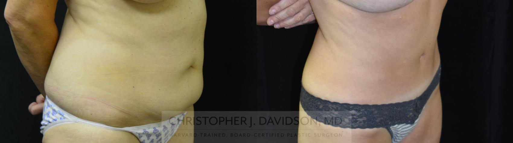 Mommy Makeover Case 401 Before & After Right Oblique | Boston, MA | Christopher J. Davidson, MD